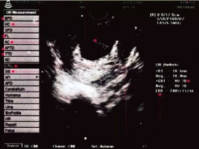 当妈妈们拿到B超纸，B超纸该如何看呢-苏州赢天堂